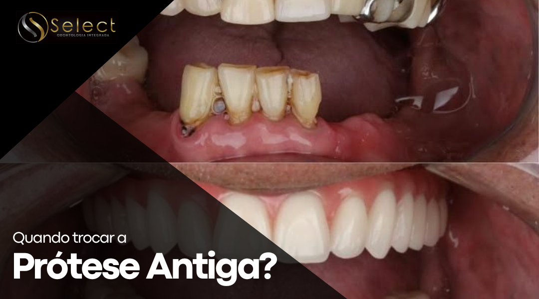 Quando trocar a prótese antiga?